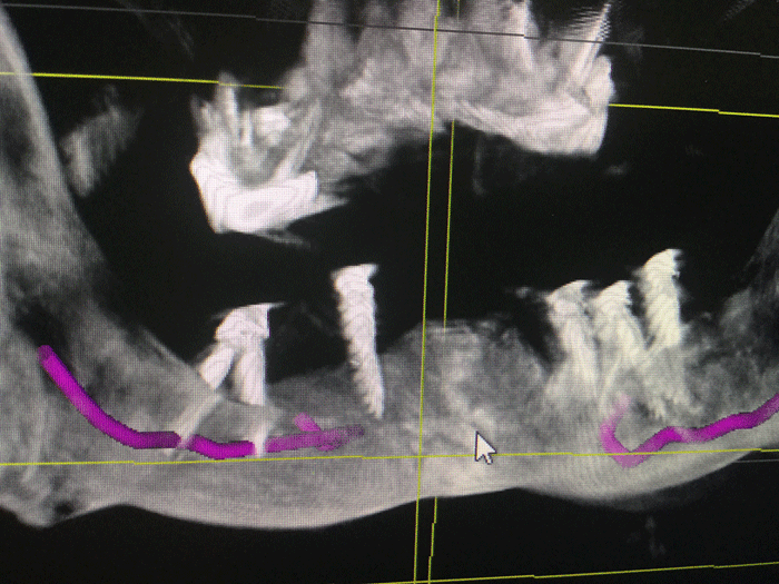 xray of very bad implants